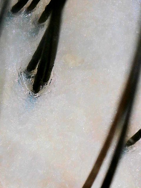 Scalp follicle view